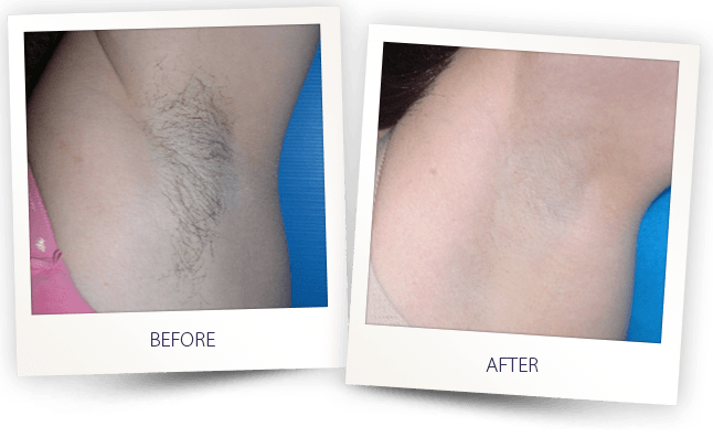 LASER HAIR REMOVAL UNDERARMS BEFORE AFTER HAIR REMOVAL UNDERARMS BEFORE AFTER