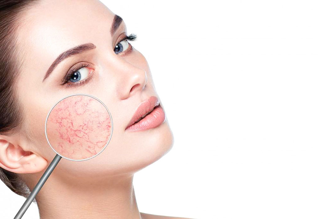 ROSACEA-and-REDNESS ROSACEA & REDNESS
