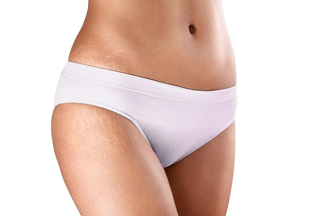 STRETCH-MARKS STRETCH MARKS