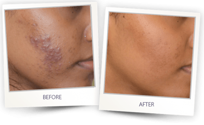 acne treatment on face acne treatment on face