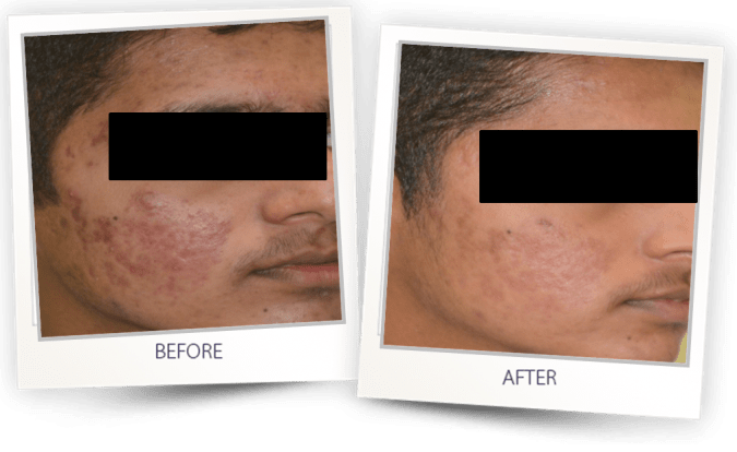 acne treatment on face acne treatment on face