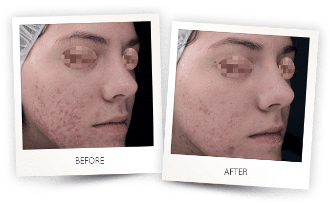 acne treatment on face acne treatment on face