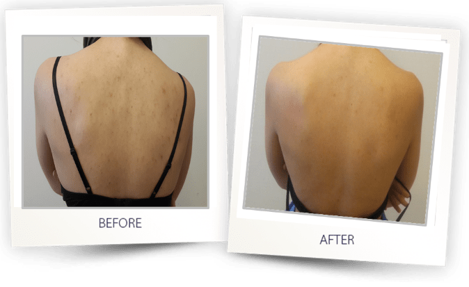 acne treatment on back acne treatment on back