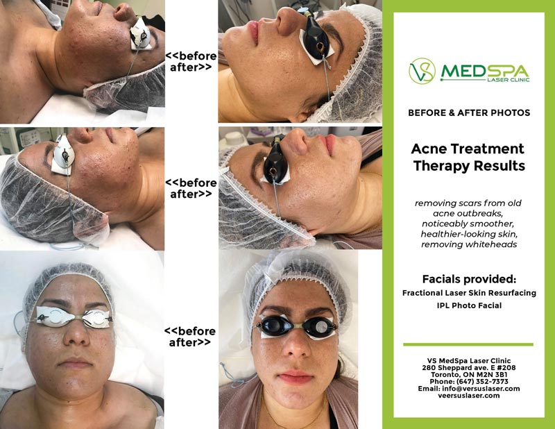 acne-treatment-therapy-results acne-treatment-therapy-results