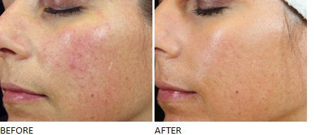 dermaquest-power-pumpkin-resurfacer-before-after dermaquest-power-pumpkin-resurfacer-before-after