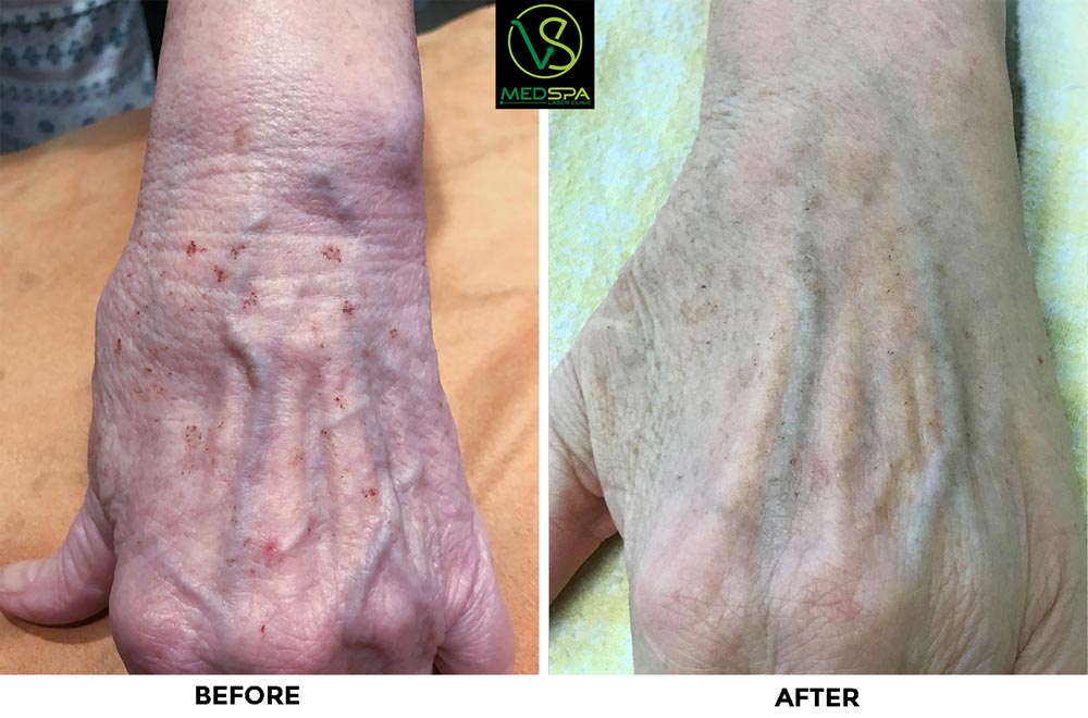 ipl hands before and after photos ipl hands before and after photos