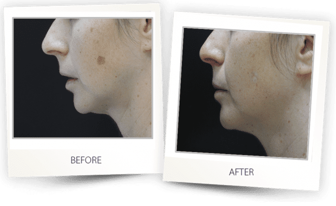 pigmented lesions treatment on face pigmented lesions treatment on face