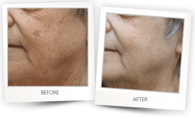 pigmented lesions treatment on face pigmented lesions treatment on face