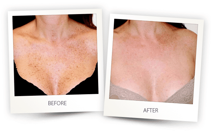 pigmented lesions treatment on chest pigmented lesions treatment on chest