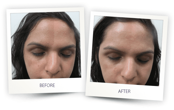 laser resurfacing laser resurfacing