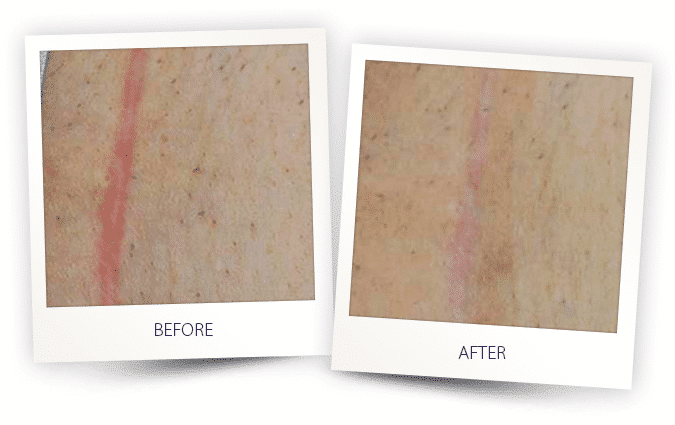 laser resurfacing laser resurfacing