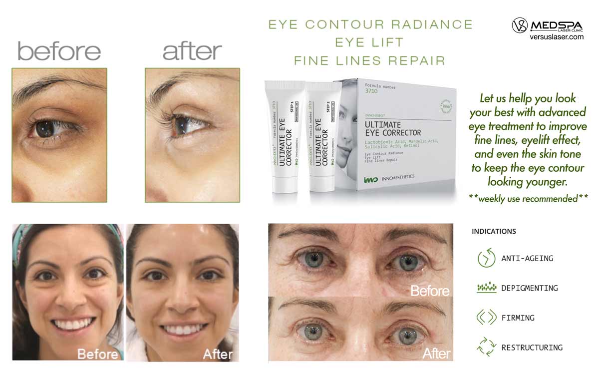 ultimate-eye-corrector-Innoaesthetics ultimate eye corrector Innoaesthetics