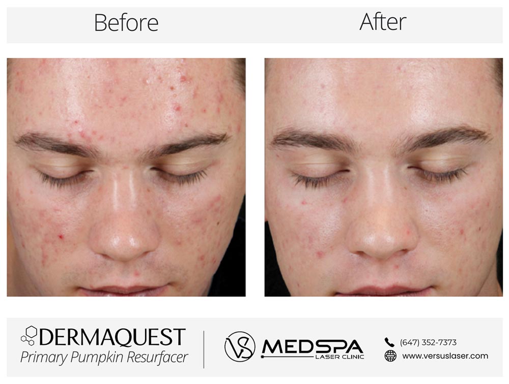 DermaQuest-Primary-Pumpkin-Resurfacer-Before-After DermaQuest-Primary-Pumpkin-Resurfacer-Before-After