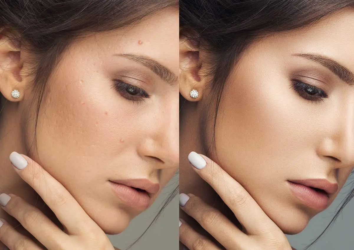 IPL-Photofacial-before-and-after-results IPL Photorejuvenation before and after