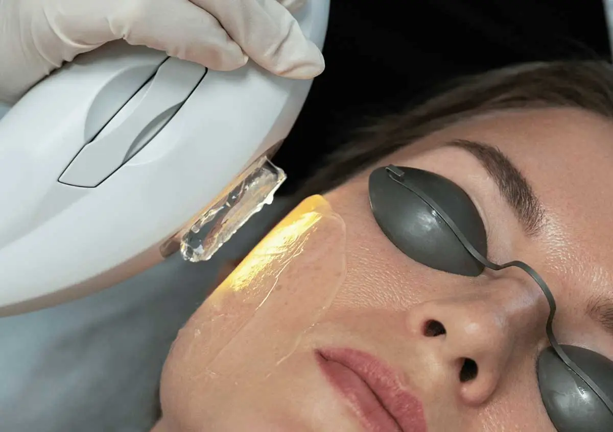 IPL-Photorejuvenation-treatment Full-Face IPL Photofacial