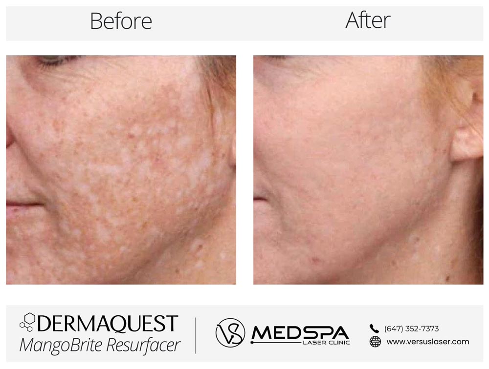 MangoBrite-Before-and-After DermaQuest MangoBrite Resurfacer Before and After