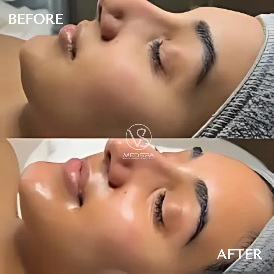 VS MedSpa Glass Skin Facial before and after