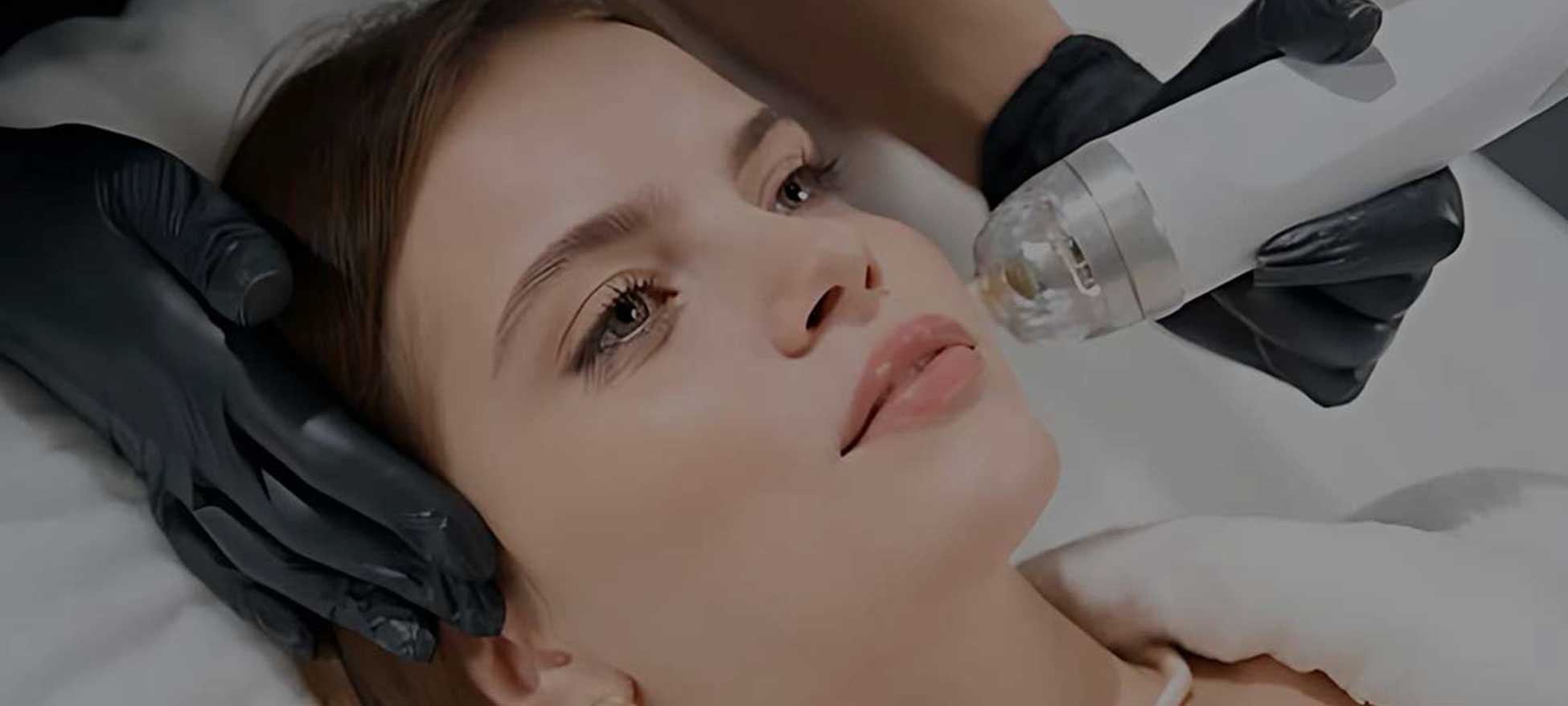 toronto microneedling