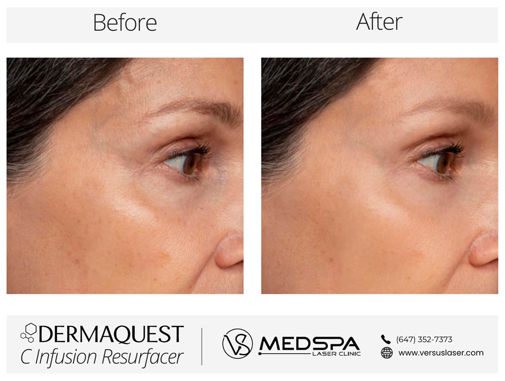 DermaQuest-C-Infusion-Before-and-After DermaQuest C Infusion Resurfacer Before and After