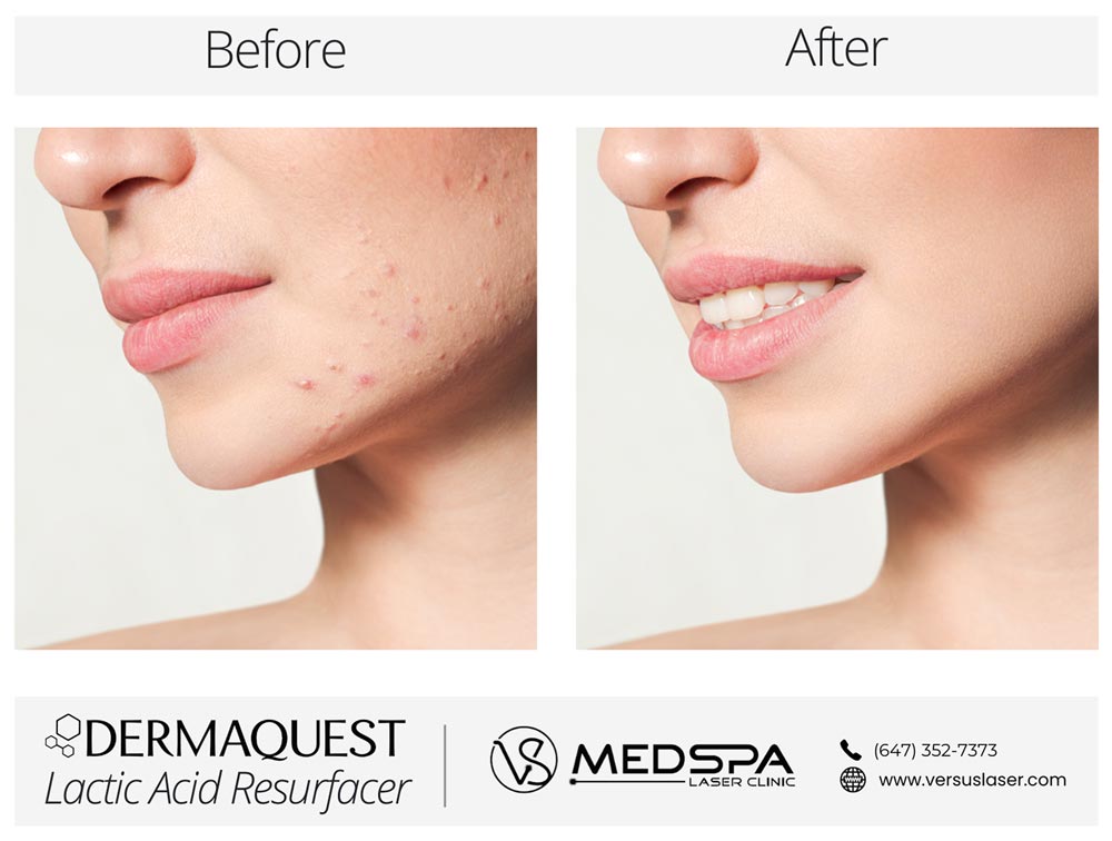 DermaQuest-Lactic-Acid-Before-and-After DermaQuest Lactic Acid Resurfacer Before After