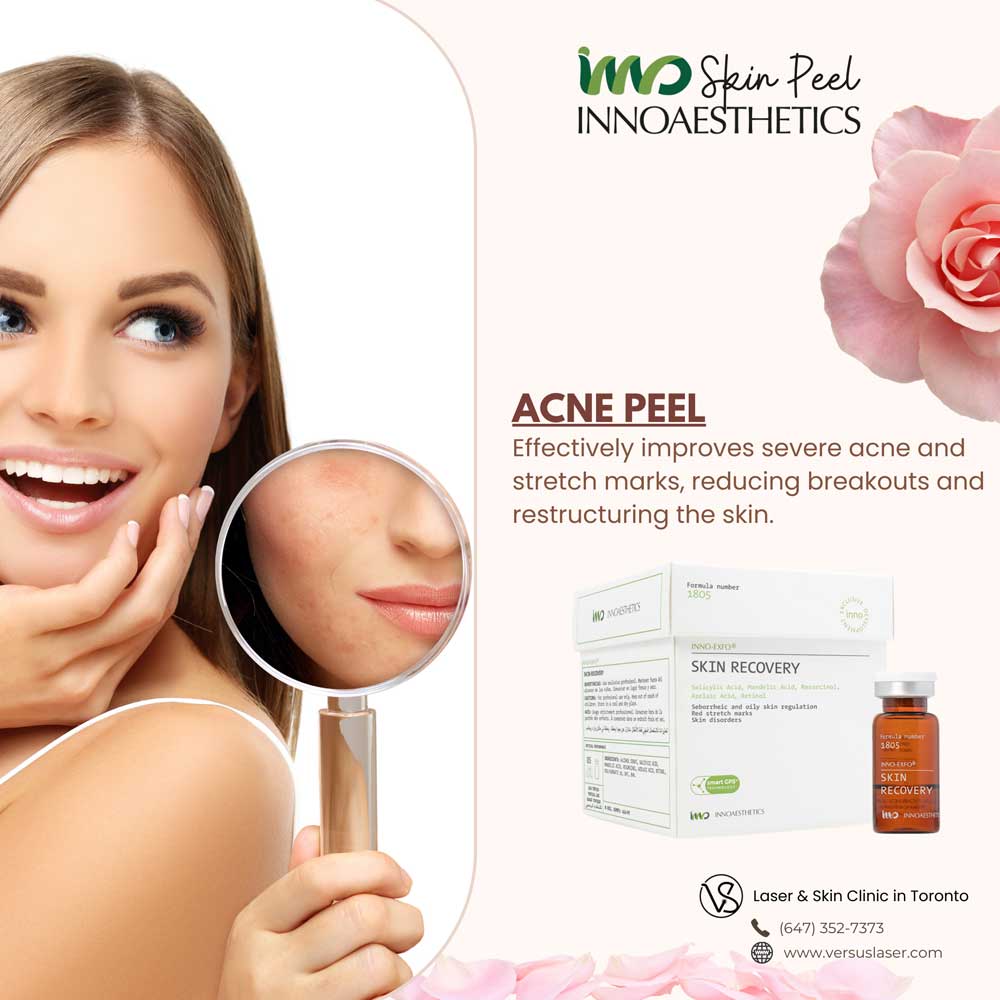 Innoaesthetics-skin-recovery-acne-peel Innoaesthetics skin recovery acne peel