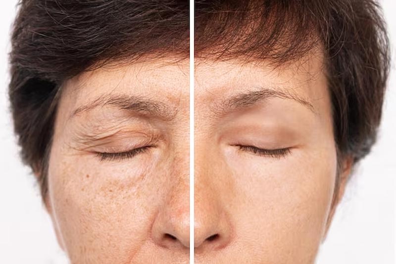 yellow peel before after pigmentation lightening yellow peel before & after pigmentation
