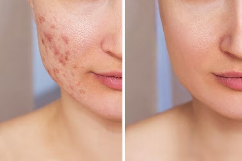 yellow peel on face before-after acne yellow peel on face before & after acne