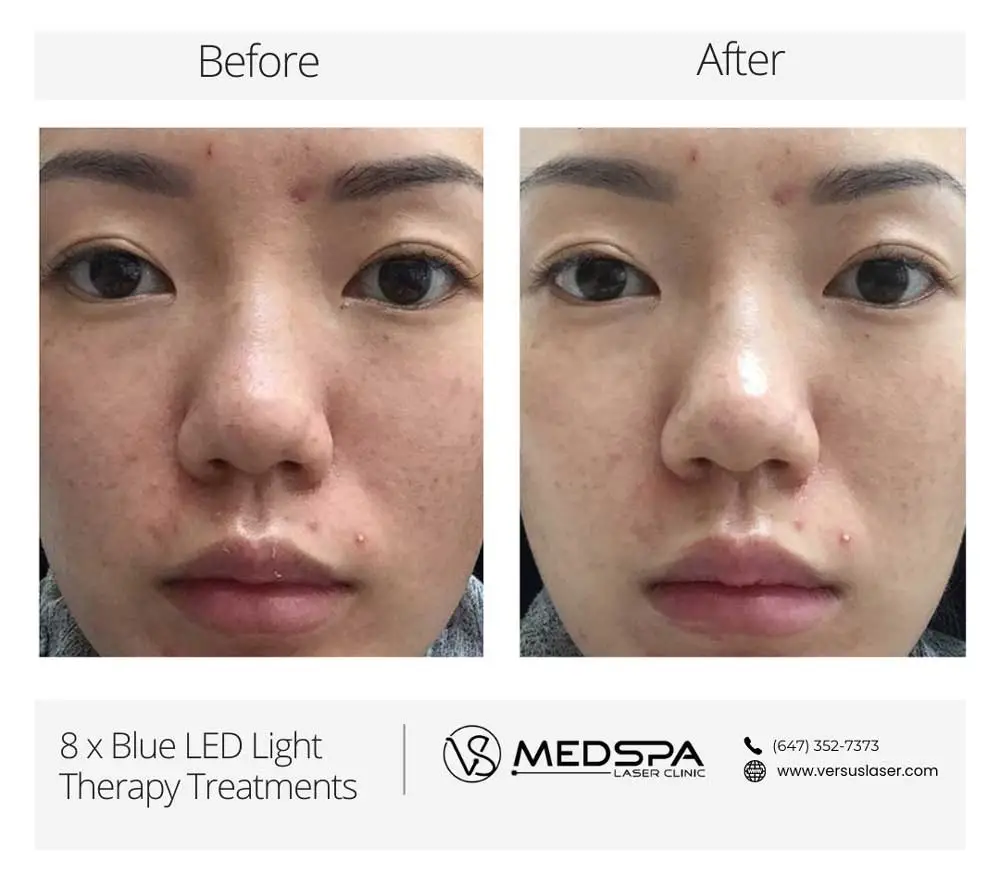 blue LED Light treatment before and after