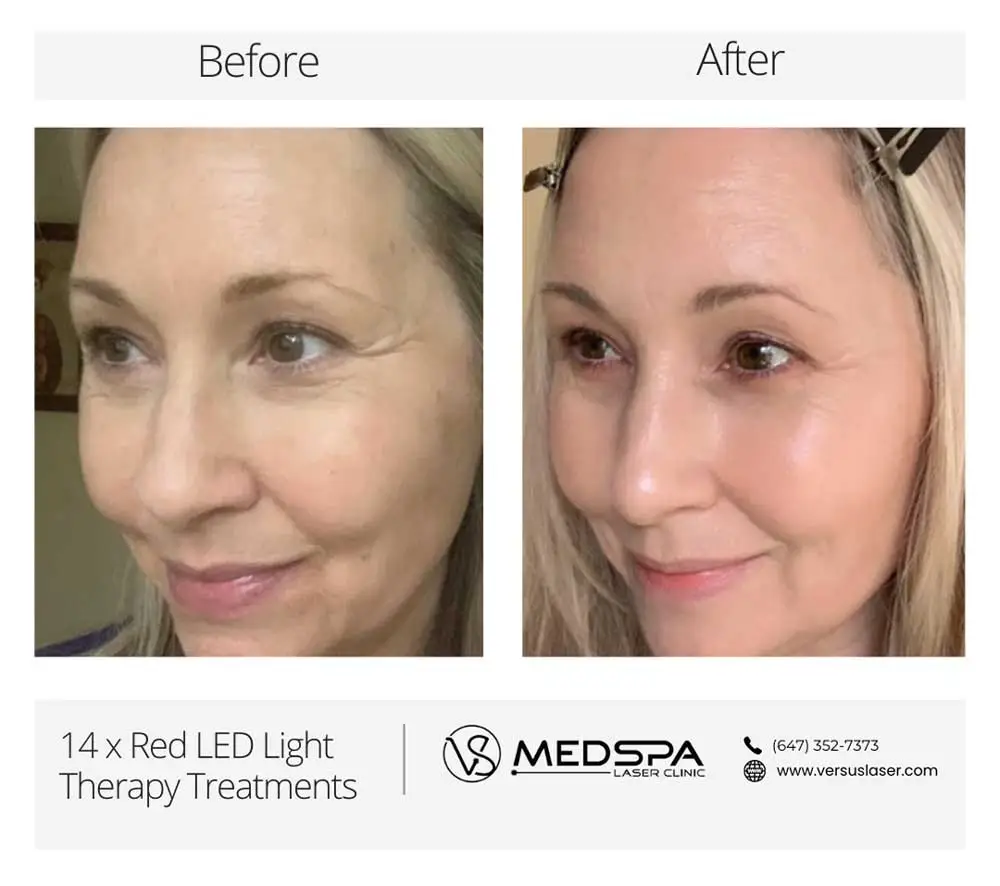 red LED Light treatment before and after