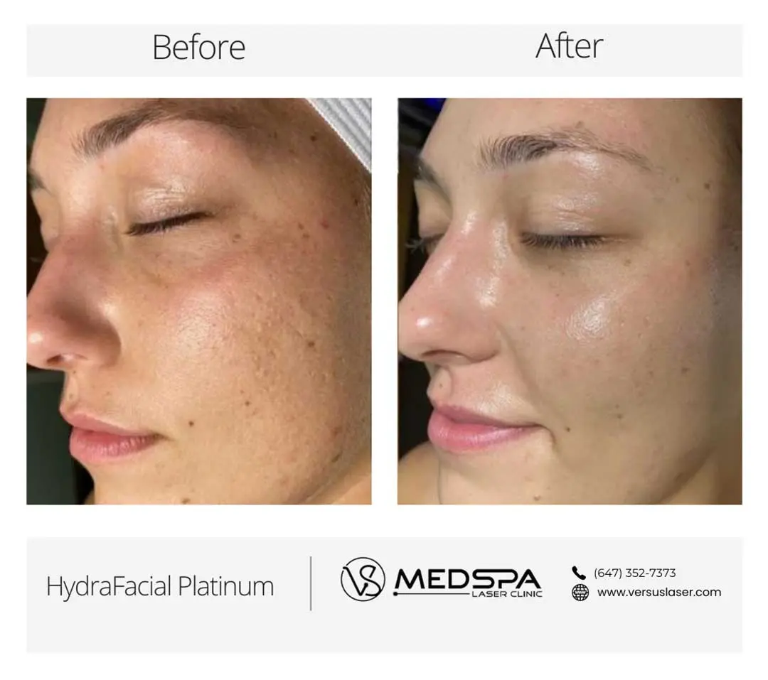 Hydrafacial-Toronto-before-and-after Hydrafacial Toronto before and after