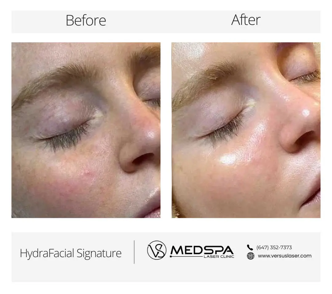 Hydrafacial-treatment-before-and-after Hydrafacial treatment before and after