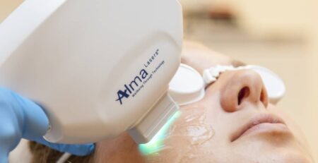 IPL photofacial session