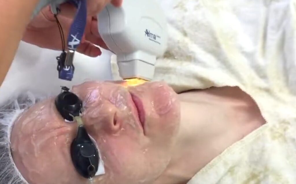 IPL photofacial reverses the effects of sun damage.