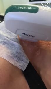 IPL Photofacials are not exclusive in the face.