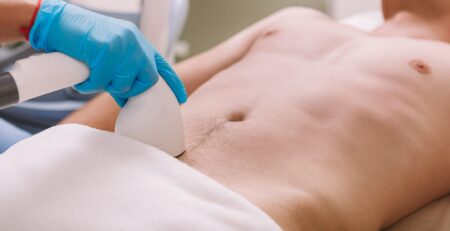 male Brazilian laser hair removal