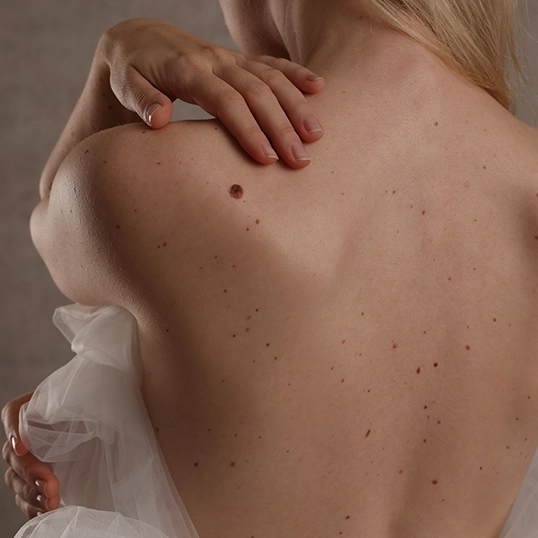 skin tag removal skin tag removal