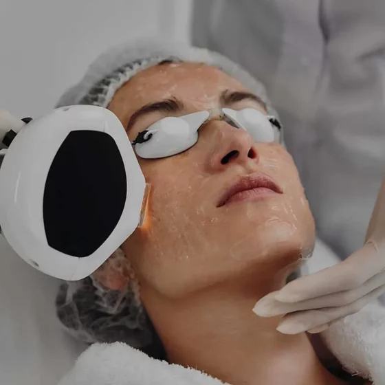 IPL-Photofacial Toronto Photorejuvenation