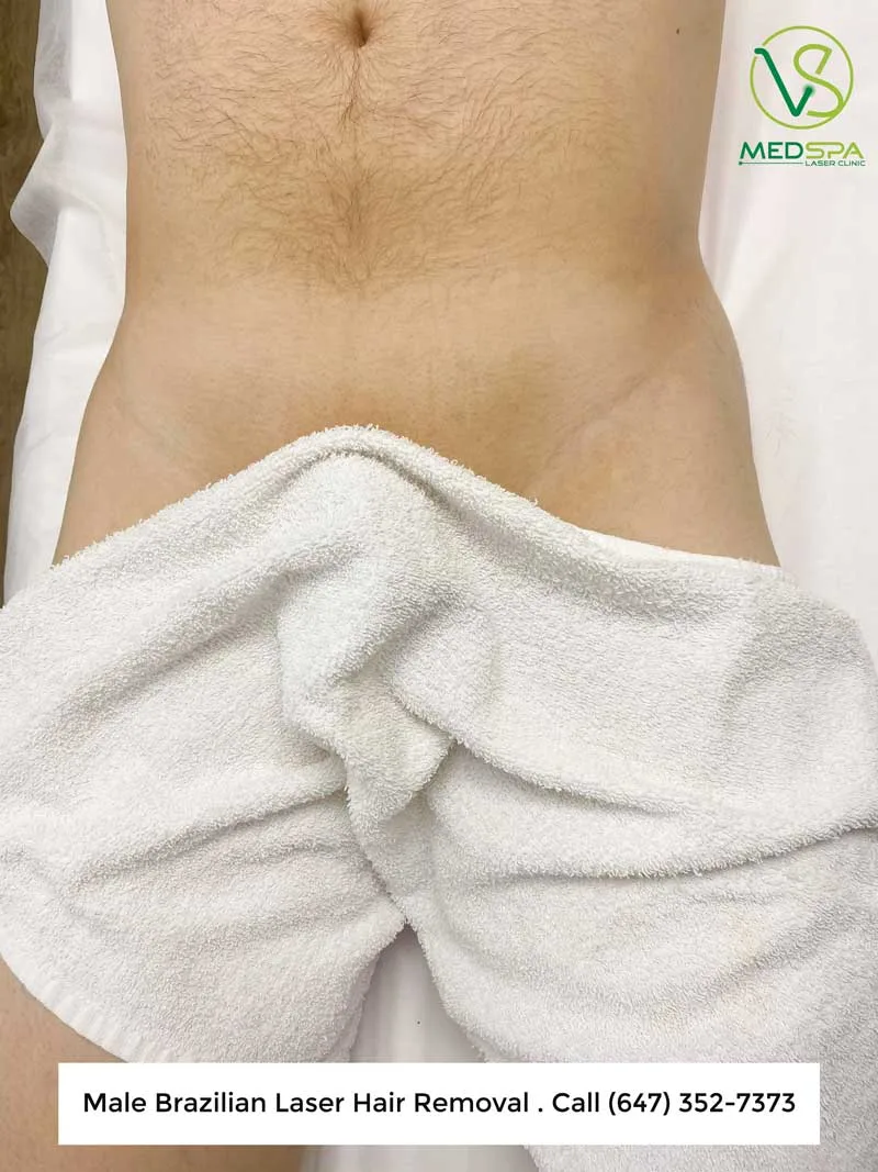 manzilian laser before and after