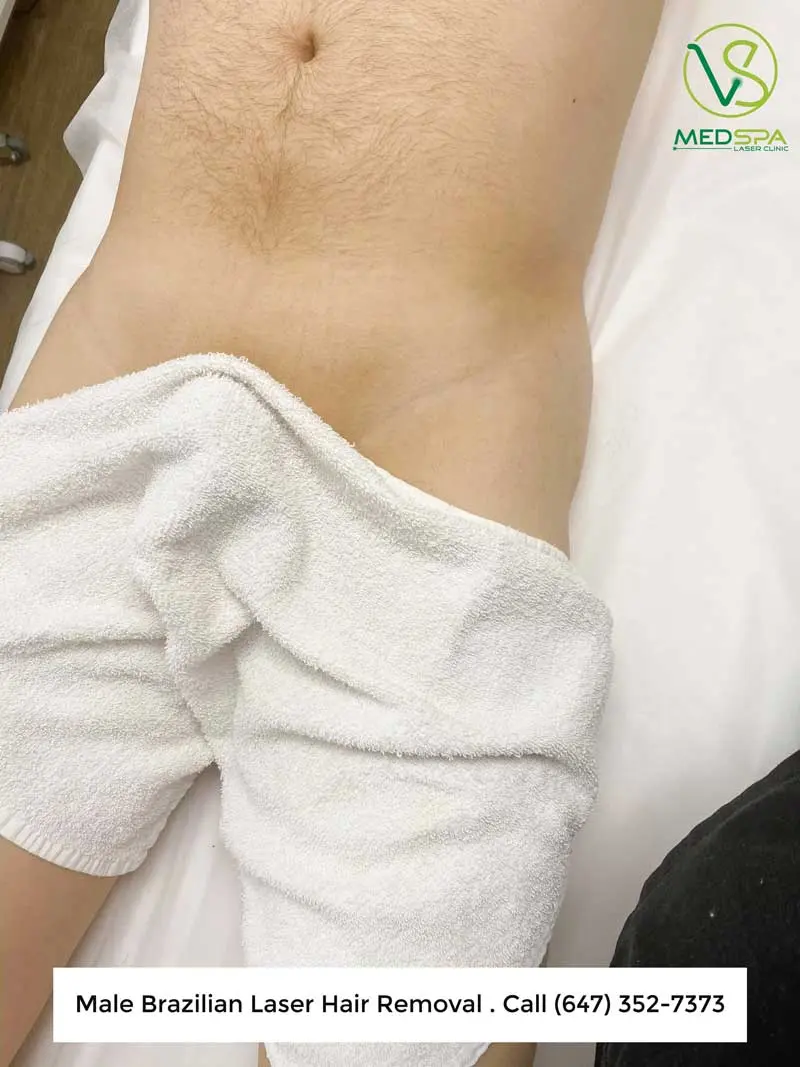 Toronto manzilian laser before and after