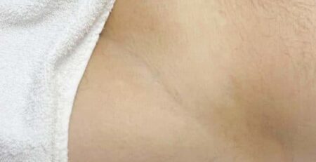 manzilian laser Toronto before and after