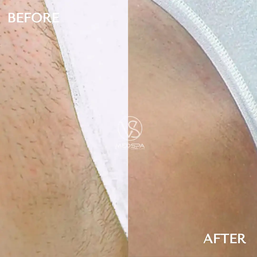 Brazilian Laser Hair Removal before and after VS MedSpa Toronto full brazilian laser hair treatment Toronto