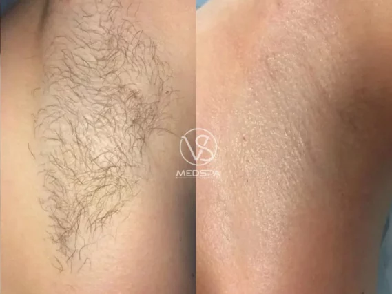 VS MedSpa laser hair removal before and after armpits