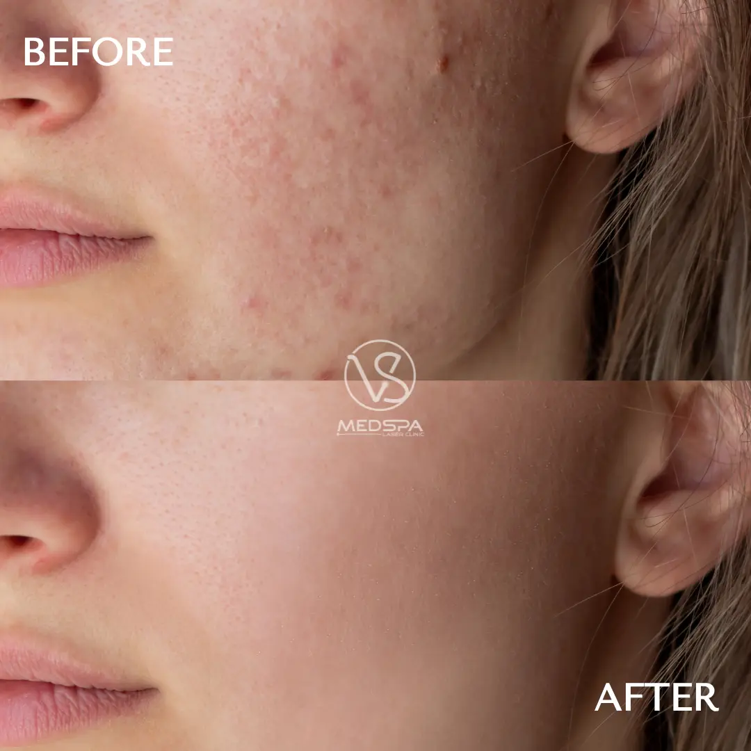 VS MedSpa Microneedling for acne scars before and after 1 Before and After Results of Microneedling for Acne Scars